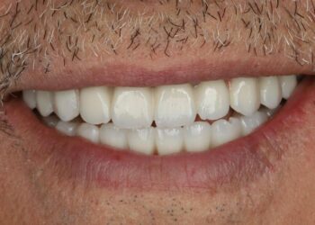 زراعة فورية للفكين باستخدام التقنية الرقمية بمدينة الملك سعود الطبية