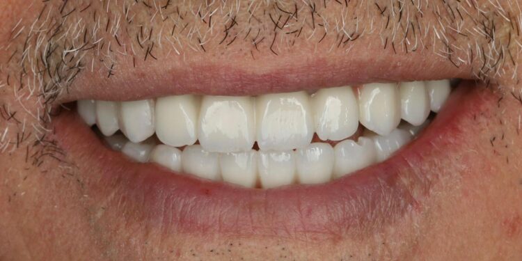 زراعة فورية للفكين باستخدام التقنية الرقمية بمدينة الملك سعود الطبية